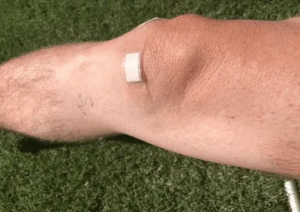 Reflection on &ldquo;Actively&rdquo; Rehabbing after Medial Meniscectomy