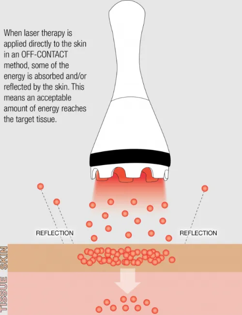 Laser Therapy through Clothing